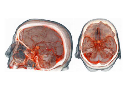 МР-ангиография артерий головного мозга, что это такое?